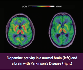 Dopamine brain activity vs Parkinson's Disease Brain Dopamine brain activity vs Parkinson's Disease Brain